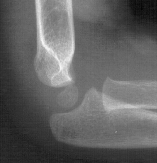 Supracondylar Humerus Fractures They can range from Nondisplaced to Completely Displaced