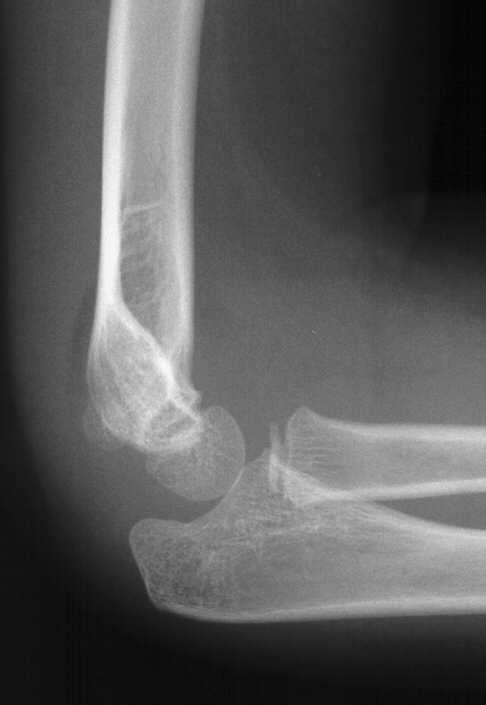 Fat Pad Occult intraarticular (injury inside the joint capsule) fracture Often is a Type I Supracondylar Fracture Blood in the Joint Creates radiographic density difference with the