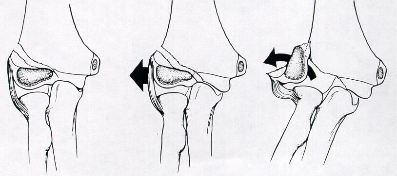 Lateral Condyle Fracture Humerus Stages of