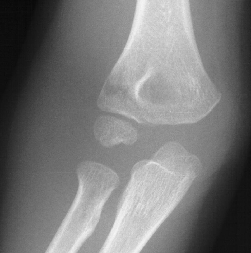 Lateral Condyle Treatment: Min (< 2