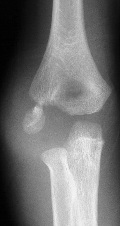Lateral Condyle Fracture Treatment: