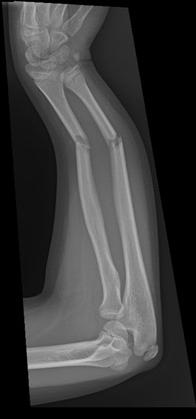 Radius and/or Ulna Fractures Fall on outstretched