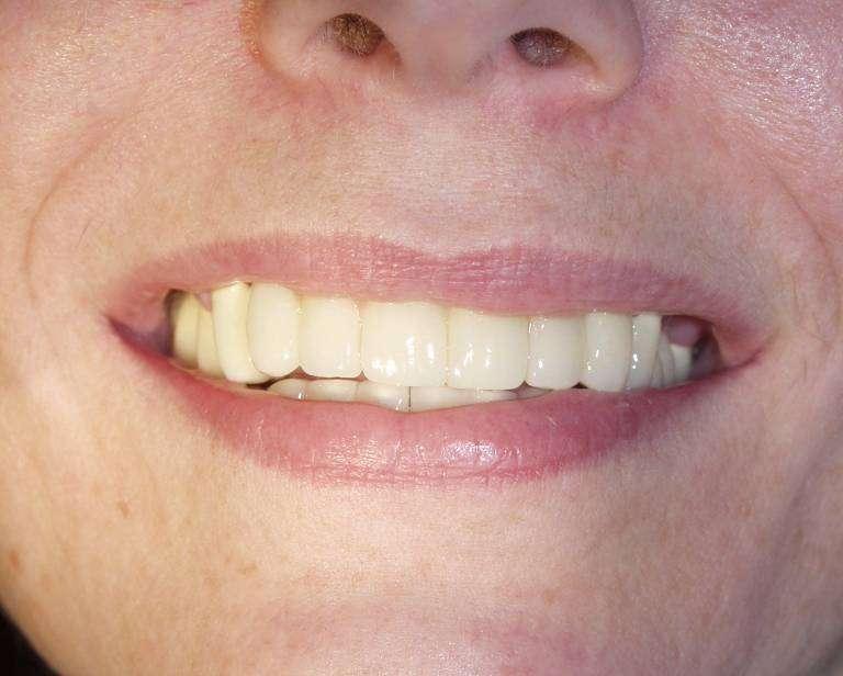 Before After with dental implants