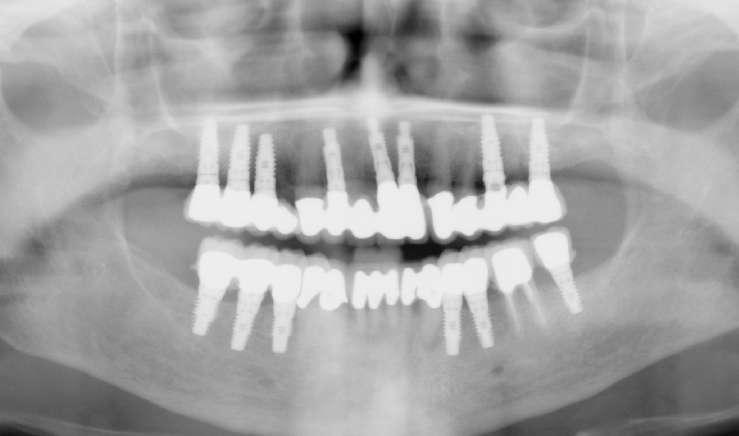 Case 2 showing dental implants