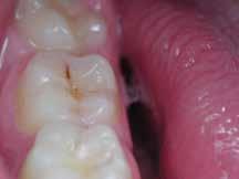 36 which correspond to early stages of dental caries occurring in the enamel, usually pass unnoticed in clinical examination, while their diagnosis at this stage allows the initiation of a