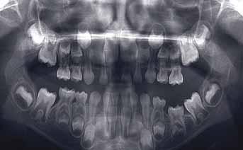 13,17,21 Consequences of infraocclusion of primary molars Tipping of adjacent teeth Overeruption of opposing teeth Lateral open bite or crossbite Caries of infraoccluded teeth or adjacent teeth