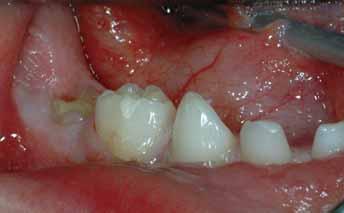 FIGURE 8: A clinical photograph of a severely infraoccluded mandibular right second molar in a five-year old.