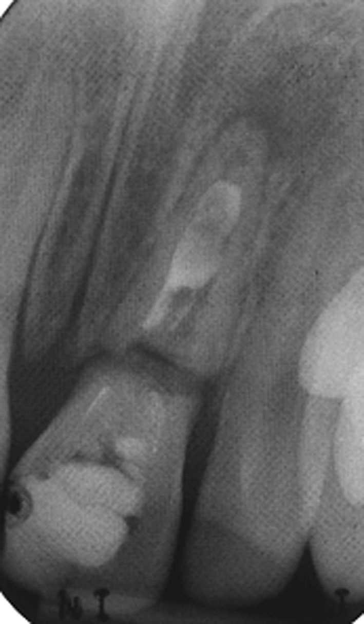 4 Eur Arch Paediatr Dent (2017) 18:3 15 Fig. 2 Clinical photographs and radiographic examination of two c cases treated with regenerative endodontic technique showing success and survival outcomes.