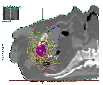 superimposed on the same patient CT slice, obtained with