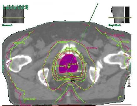 GTV Medulla oblongata PTV a) Control Brain Body Prostate