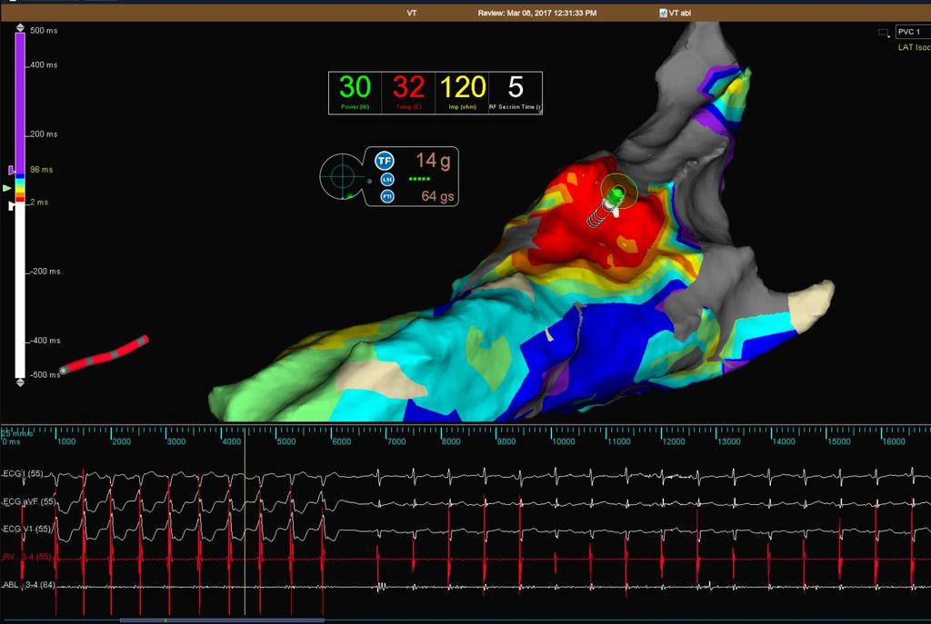 Focal VT VT, ablation on Termination at 5 seconds