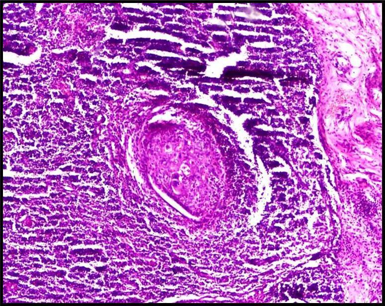 pattern 1 5% Glandular pattern 1 5% Pagetoid pattern 6 35% Figure 2: Radical neck dissection specimen in a case of recurrent malignant proliferating trichelemmal tumor.