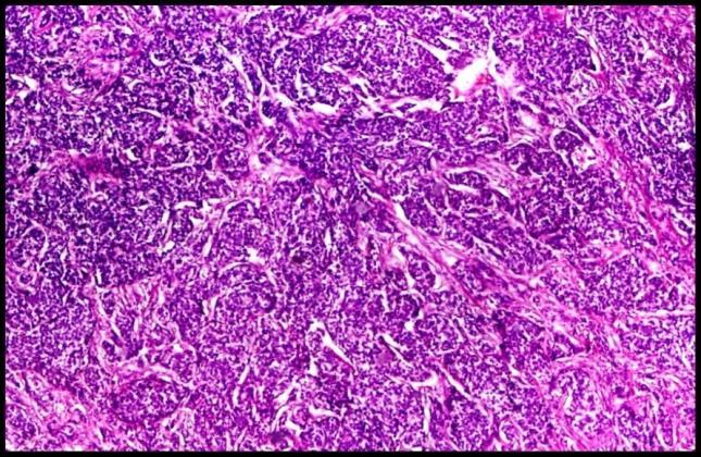 Figure 6: Sheeting pattern of pleomorphic tumor cells in a case of recurrent ocular sebaceous carcinoma (H&E, 4x).