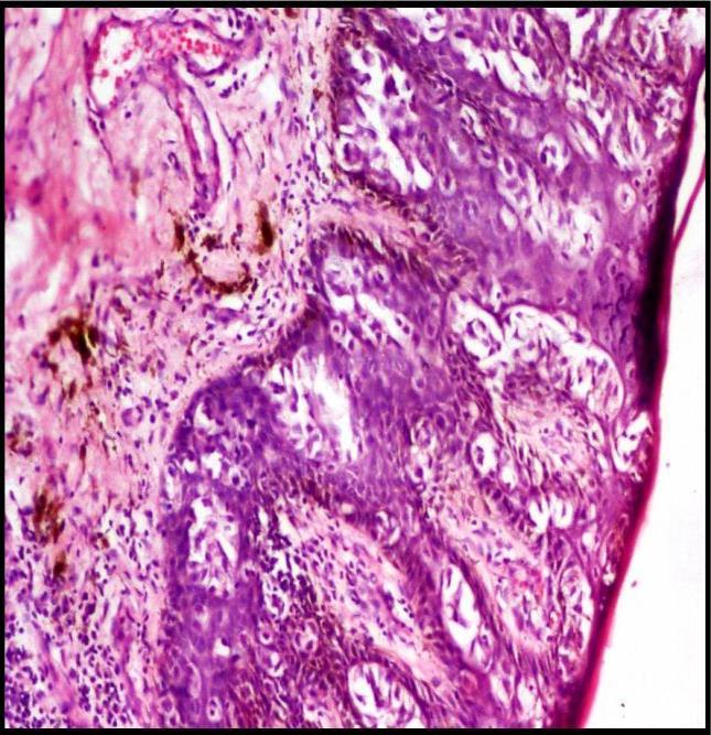 DISCUSSION Skin adnexal epithelial neoplasms are an assorted group of tumors that show differentiation towards pilosebaceous, eccrine or apocrine structures.