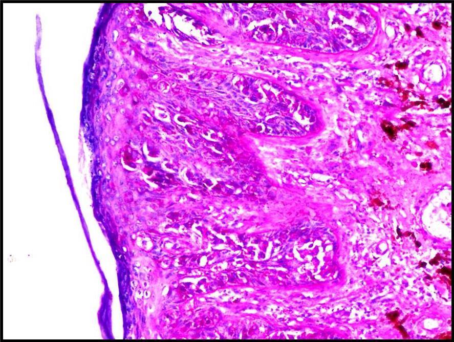 A malignant counterpart of almost every skin adnexal tumors has been described.