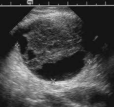 From above discussion, we conclude that the ultrasound and colour doppler imaging are excellent modalities in describing the nature of adnexal pathologies; more over they are cheap, non-invasive and