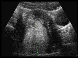 Fig. 7 (Patient A) Trans abdominal ultrasound shows cyst