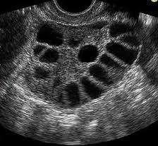 Fig. 13: Transvaginal ultrasound shows enlarged ovary with multiple peripherally arranged follicles- Polycystic ovarian disease Fig.