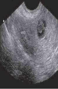 15: Transvaginal ultrasound shows normal uterus with echogenic fetal poles in adnexa- Ectopic pregnancy REFERENCES 1.