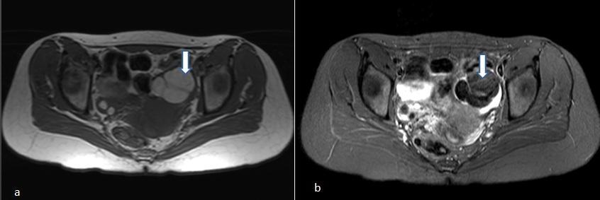 Page56 Figure 1: Dermoid : Axial T1 weighted MR image(a) showing a bright adnexal lesion on left side (arrow) with loss of this bright signal on fat suppressed post contrast T1- weighted image(b),