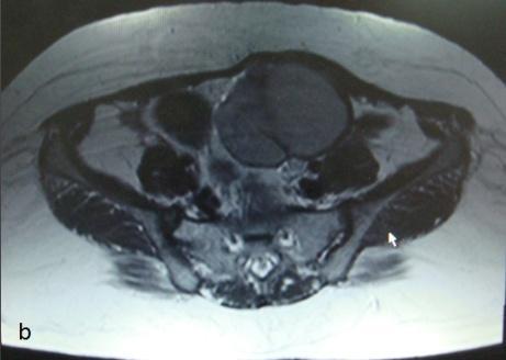 Figure 2: Endometrioma: Axial T1-weighted MR image (a) showing a bright adnexal lesion on left side which appears hypointense on T2-weighted image (b) with a well defined hypointense rim
