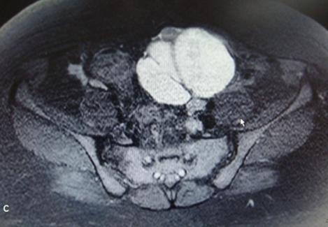 Simple Cyst: A simple adnexal cyst appears as a homogenous low signal intensity structure on T1 weighted images and high signal intensity structure on T2-weighted images.