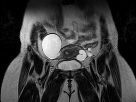 Figure 5: Ovarian Torsion: Axial T2-weighted MR image showing enlarged left ovary with peripherally arranged follicles and edematous stroma