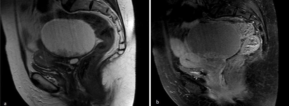 Page58 Figure 8: Endometrioid Tumour: Sagittal T2-weighted (a) and post contrast fat suppressed T1-weighted MR image showing a cystic lesion with enhancing solid component within it, which at