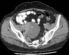 Ovarian metastases Krukenberg