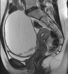 MRI correct diagnosis of benign lesion Haemorrhage,