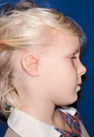There may be a spectrum of external ear deformities with various degrees of involvement of the middle and inner ear.