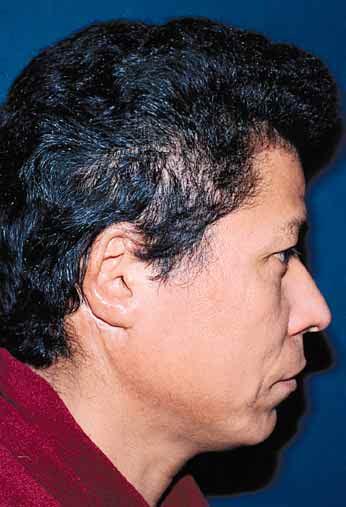 Postoperative result after staged reconstruction.