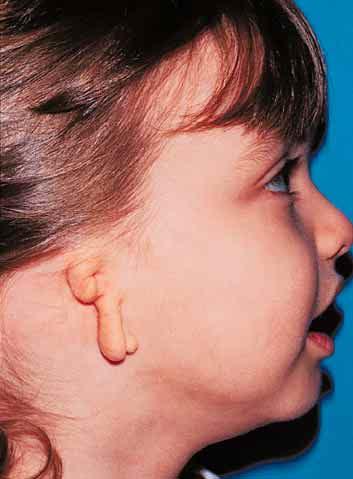 circumstance in which this type of staged cartilage reconstruction can be