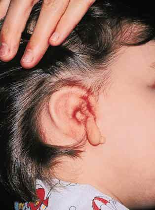 The amount of ear loss determines the types and stages of reconstruction needed.