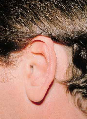 The ear s prominence is due to lack of development of the antihelical fold.