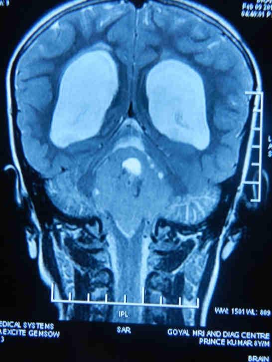 heterogeneously enhancing mass lesion Figure 4 - Postoperative NCCT head axial section showing excision of medulloblastoma After reversal of anaesthesia, he was awake with intact neurologically,