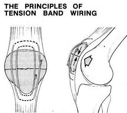 Internal fixation Wires fixation of patella Strong surgical wire is passed over the anterior surface of
