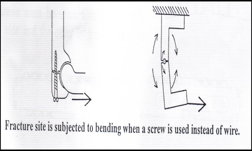 Screws Difference between wires and screws 1-The fixation (or fulcrum) is not at the end of the
