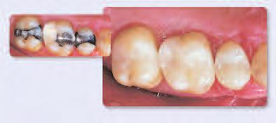 It can be used for the fabrication of all-ceramic restorations for individual teeth, such as inlays, onlays, crowns,