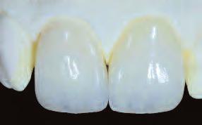 Empress System A variety of characterization options Your IPS Empress restorations can be characterized according to the