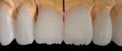 The lobes you cut into the incisal edge should look like a serrated knife blade; however, be careful not to create sharp lines of demarcation.