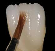 Layering Layering for Incisal Effect Reverse illumination shows the translucency