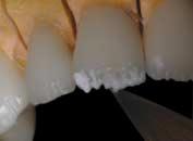 Fill in with Opal Incisal HT (High Translucent) to silhouette the structure