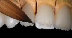 The silhouette of the tooth is filled out, but note that the buildup is very