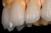 Opal Incisal HT (High Translucent) is