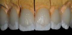 are complete, but the incisal third must