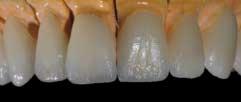 Incisal shape is reestablished by