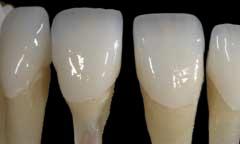 Incisal translucency patterns are soft, feathery, and natural in appearance.
