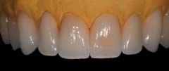 IPS EMPRESS ESTHETIC Contacts should extend from the incisal