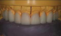 An incisal matrix is used to record the incisal edge